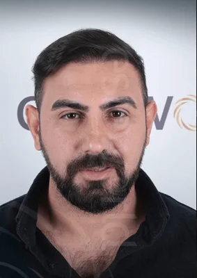 Hair Transplant - After