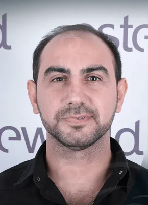Hair Transplant - Before
