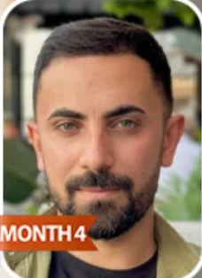 Hair Transplant - After
