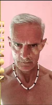 Hair Transplant - After