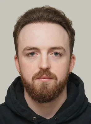 After — FUE Hair Transplant