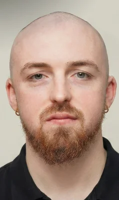 FUE Hair Transplant - Before
