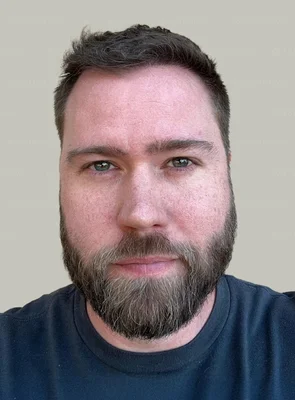 After — DHI Hair Transplant