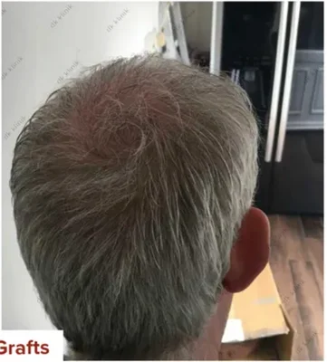 After — Hair Transplant