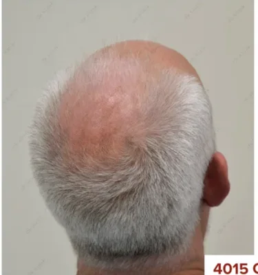 Before — Hair Transplant
