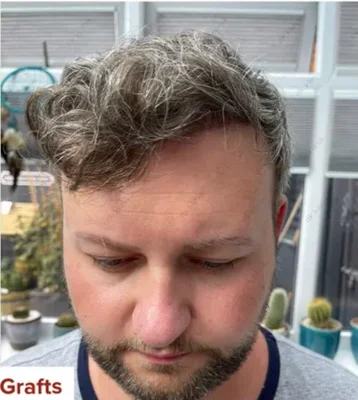After — Hair Transplant