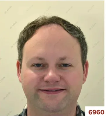 Before — Hair Transplant