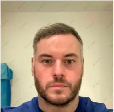 After — Hair Transplant