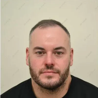 Before — Hair Transplant
