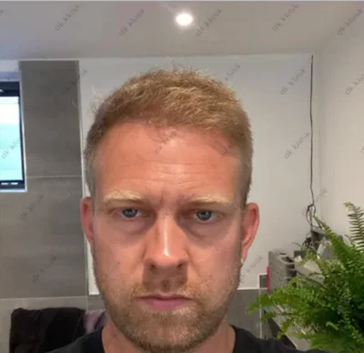 After — Hair Transplant