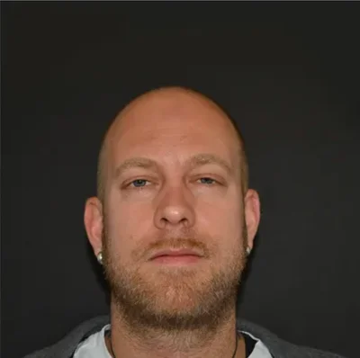 Before — Hair Transplant