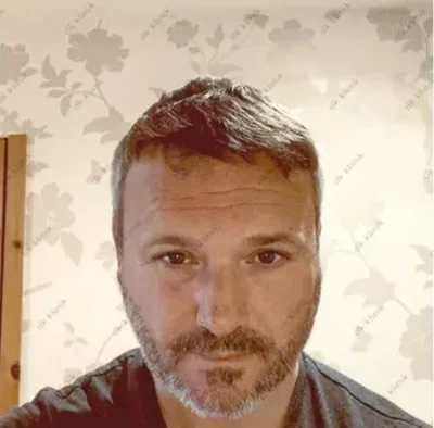 After — Hair Transplant