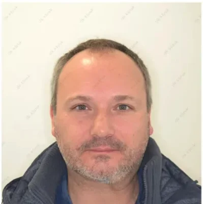 Before — Hair Transplant