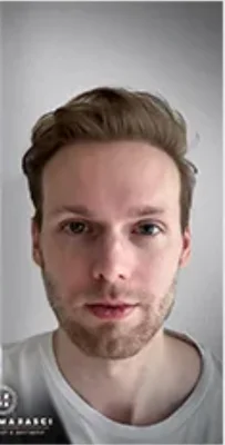 After — Hair Transplant