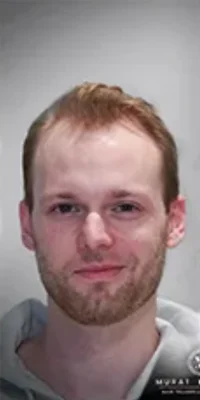Before — Hair Transplant