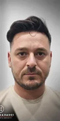 After — Hair Transplant