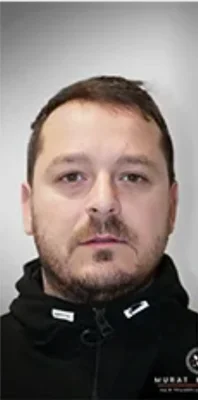 Before — Hair Transplant