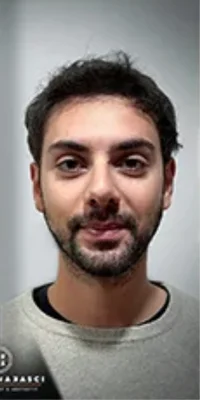 After — Hair Transplant