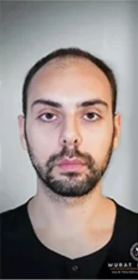 Before — Hair Transplant