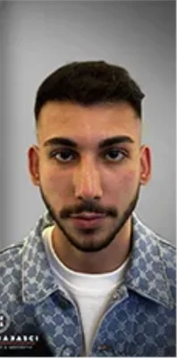 After — Hair Transplant