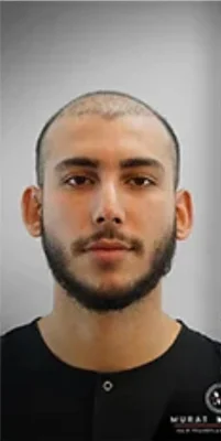 Before — Hair Transplant