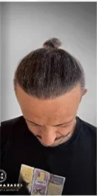 After — Hair Transplant