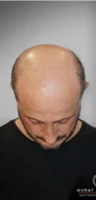 Before — Hair Transplant