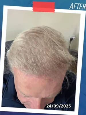 After — Hair Transplant