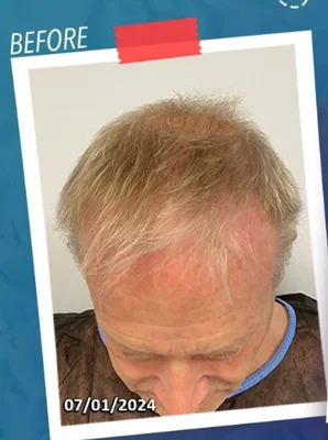 Before — Hair Transplant