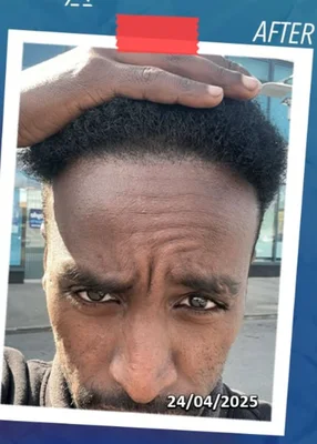 After — Hair Transplant