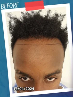 Before — Hair Transplant