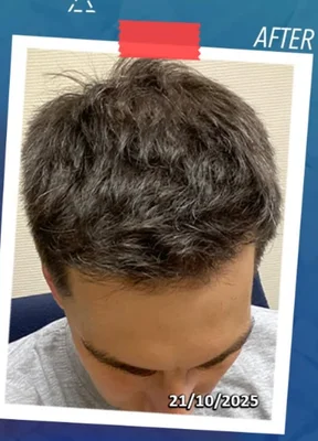 After — Hair Transplant
