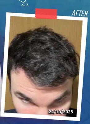 After — Hair Transplant