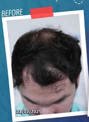 Before — Hair Transplant