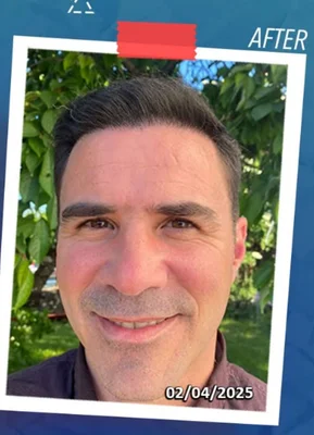 After — Hair Transplant
