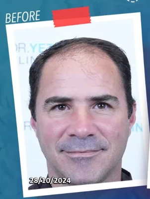 Before — Hair Transplant