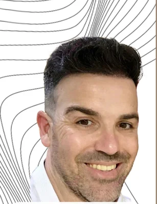 After — Hair Transplant