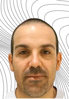 Before — Hair Transplant