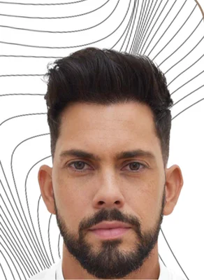 After — Hair Transplant