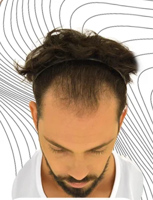 Before — Hair Transplant