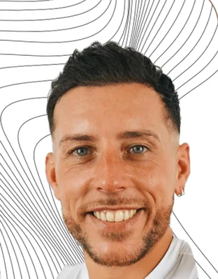 After — Hair Transplant