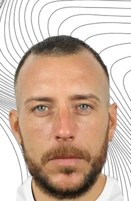 Before — Hair Transplant