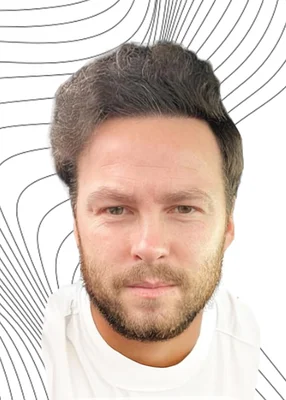 After — Hair Transplant