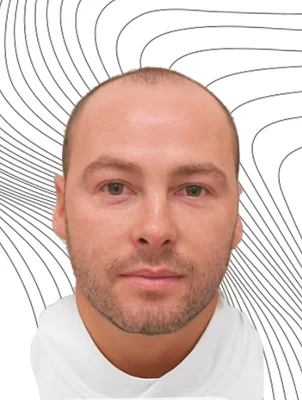 Before — Hair Transplant