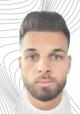 After — Hair Transplant