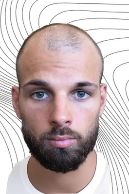 Before — Hair Transplant