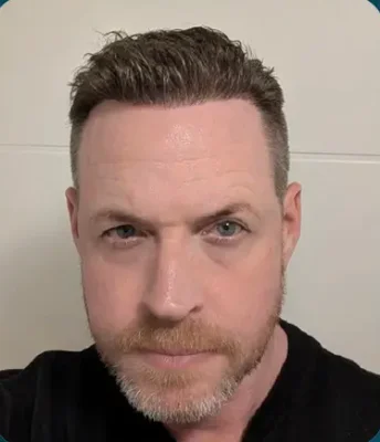 After — FUE Hair Transplant