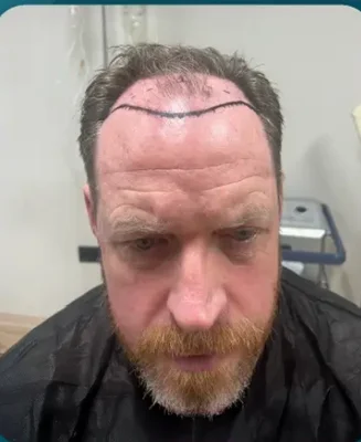 Before — FUE Hair Transplant