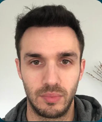 After — FUE Hair Transplant