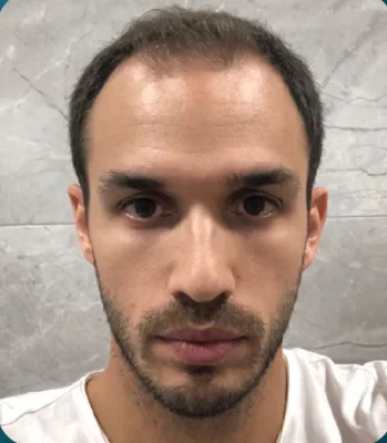 Before — FUE Hair Transplant